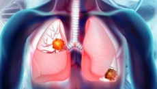 ung thư phổi giai đoạn cuối: Những điều cần biết