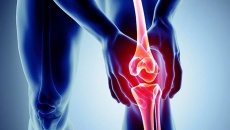 Dấu hiệu cảnh báo bệnh thoái hóa khớp gối và cách phòng ngừa bệnh