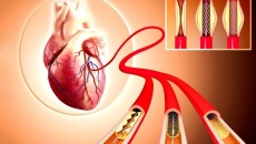 Tắc hẹp mạch vành: Điều trị thế nào trong trường hợp trì hoãn đặt stent?