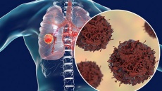 Tìm hiểu về ung thư phổi giai đoạn cuối