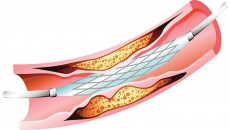 Nên làm gì để trì hoãn việc đặt lại stent động mạch vành?