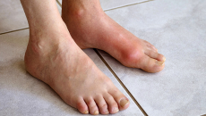 Biểu hiện gout cấp tính và những sai lầm khi điều trị