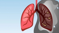 Cách đối phó với ung thư phổi giai đoạn 3