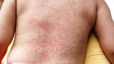 Gia tăng số ca sốt xuất huyết có dấu hiệu cảnh báo ngay từ đầu mùa dịch