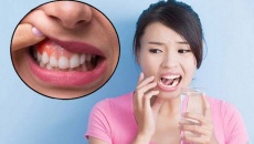 Bật mí cách phòng ngừa viêm quanh răng hiệu quả 