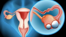 Chế độ ăn cho người mắc u nang buồng trứng  