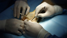 Bệnh viện Đại học Y Hà Nội phẫu thuật cứu bàn tay dập nát