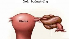 Xoắn hoại tử buồng trứng: Cẩn thận chẩn đoán nhầm