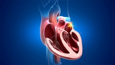Đốt điện tim điều trị rối loạn nhịp tim có hiệu quả không?