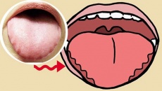 Dấu hiệu trên lưỡi cảnh báo bạn đang thiếu vitamin B12