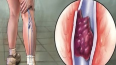 3 cách ngăn ngừa hình thành cục máu đông ở chân