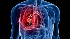 Ung thư phổi không tế bào nhỏ phẫu thuật được không?