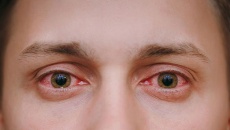 Dịch đau mắt đỏ lây lan cả nước, Bộ Y tế khuyến cáo 5 biện pháp phòng bệnh