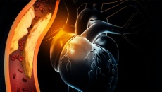 Bị thiếu máu cơ tim nhưng không có triệu chứng có cần điều trị không?