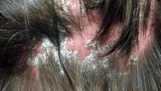 Những ai có nguy cơ mắc bệnh vảy nến da đầu?