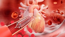 Bị suy tim, đã đặt stent có dùng TPBVSK Ích Tâm Khang được không?