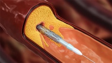 Người bệnh thiếu máu cơ tim có thể gặp biến chứng gì sau đặt stent?