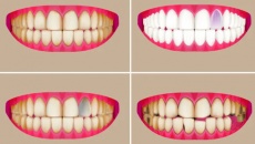 Màu sắc răng tiết lộ điều gì về sức khỏe? 