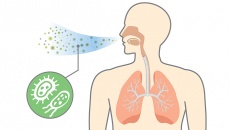 Nguyên nhân gây viêm phổi kéo dài