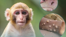 Bộ Y tế 'nhắc' giám sát và phát hiện sớm ca bệnh đậu mùa khỉ