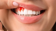 “Thủ phạm” gây chảy máu chân răng và cách cải thiện