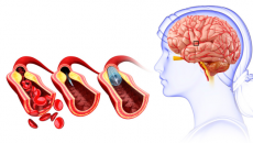 Hẹp động mạch cảnh - hiểm họa âm thầm gây tai biến mạch máu não