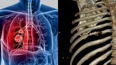Biện pháp nâng cao sức khỏe cho người bệnh ung thư phổi di căn xương 