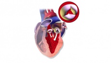 Hở nhiều van tim cùng lúc kèm đau ngực, khó thở làm sao cải thiện?