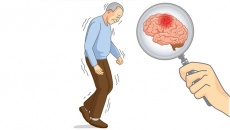 Hội chứng Parkinson do rối loạn ngoại tháp là tình trạng gì?