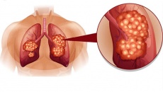 Ung thư phổi giai đoạn 2 và những thông tin hữu ích 