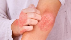 Người bệnh chàm eczema nên bổ sung dưỡng chất nào?