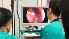 Nội soi gắp kim diệt tủy răng trong bụng bé trai 8 tuổi tại Thái Nguyên