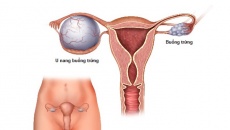 Tìm hiểu về các dạng u nang buồng trứng thường gặp
