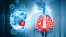 Đâu là nguyên nhân gây ung thư phổi phổ biến?