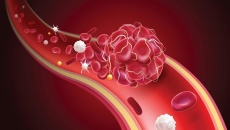 3 biện pháp hỗ trợ phòng ngừa cục máu đông  