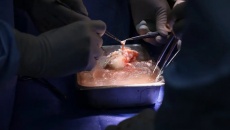 Bệnh nhân được ghép thận lợn biến đổi gene đã xuất viện