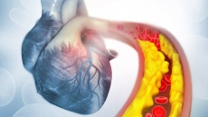 Thiếu máu cơ tim kèm bệnh mạch vành, cần làm gì để giảm nguy cơ đặt stent?