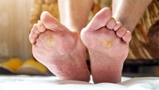 Đái tháo đường: 5 lời khuyên giúp phòng ngừa biến chứng loét bàn chân