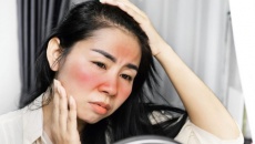 Da cháy nắng, cách điều trị và phòng ngừa thế nào?