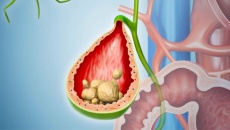 Người bệnh chia sẻ: Bí quyết giúp tan sỏi bùn lấp đầy túi mật