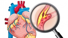 Vôi hóa mạch vành là bệnh gì, phải làm sao để cải thiện?
