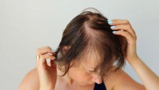 Tránh 5 sai lầm này để ngăn rụng tóc và hói đầu sớm