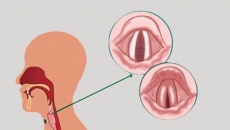 Nguyên nhân gây viêm thanh quản mạn và cách đối phó hiệu quả