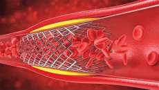 Bị bệnh mạch vành nhưng không đặt stent có được không? 