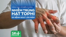 Podcast: Cảnh giác với biến chứng nhiễm trùng hạt tophi do bệnh gout lâu năm