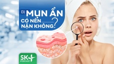 Podcast: Bị mụn ẩn có nên nặn không?