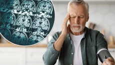 Mối liên hệ giữa tăng huyết áp và bệnh Alzheimer