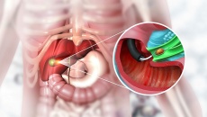 Xử trí thế nào khi bị viêm túi mật?