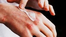 Biện pháp chăm sóc da tự nhiên cho người mắc bệnh chàm eczema