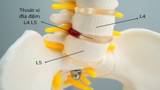 Cách giảm đau lưng do thoát vị đĩa đệm L4 L5 hiệu quả tại nhà 